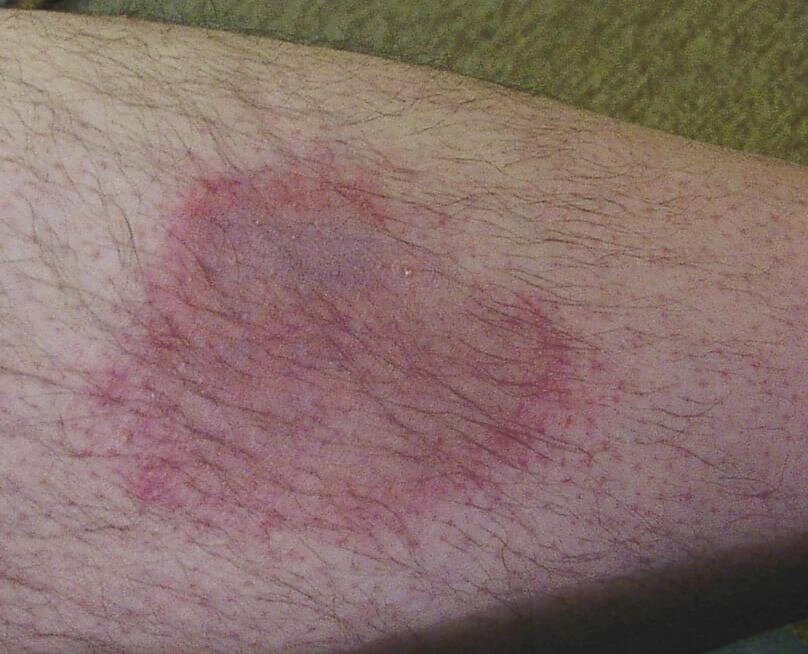 lyme disease rash pictures