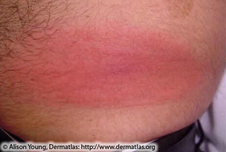 lyme disease rash pictures