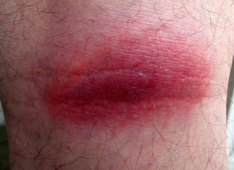 lyme disease rash pictures