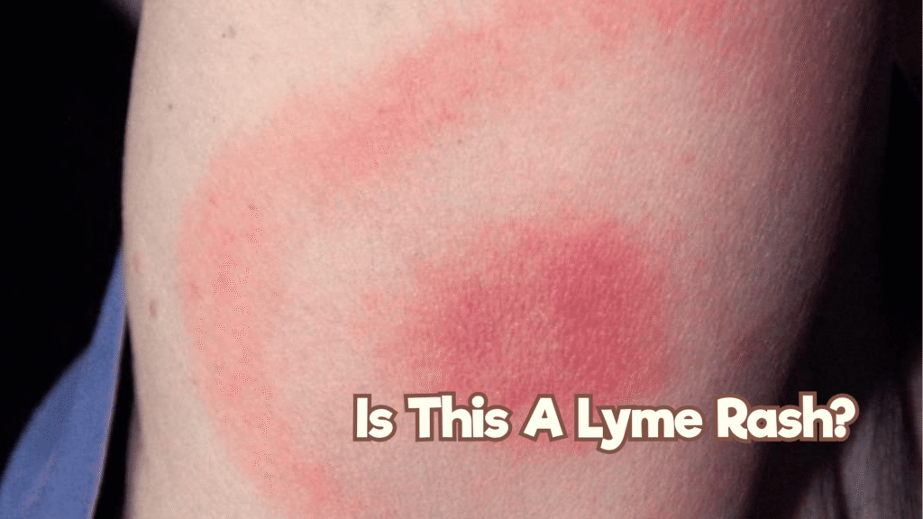 lyme rash home page (1)