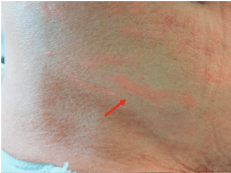 Strongyloides rash showing raised red larva currens tracks on the lower abdomen