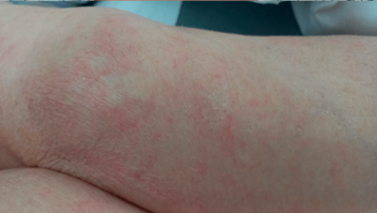 Widespread strongyloides skin rash across the torso